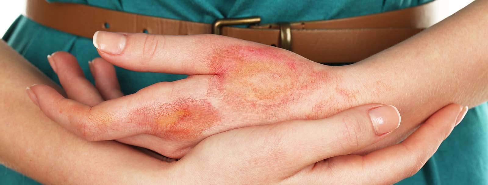kezét vörös foltok és égési sérülések borítják